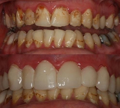 Nappy Lam Dds Portland Oregon Dentist Before And Afters